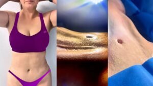 Lipo Marcación Abdominal: Precisión y Arte en la Cirugía Plástica del Dr. Elmer Terrazas