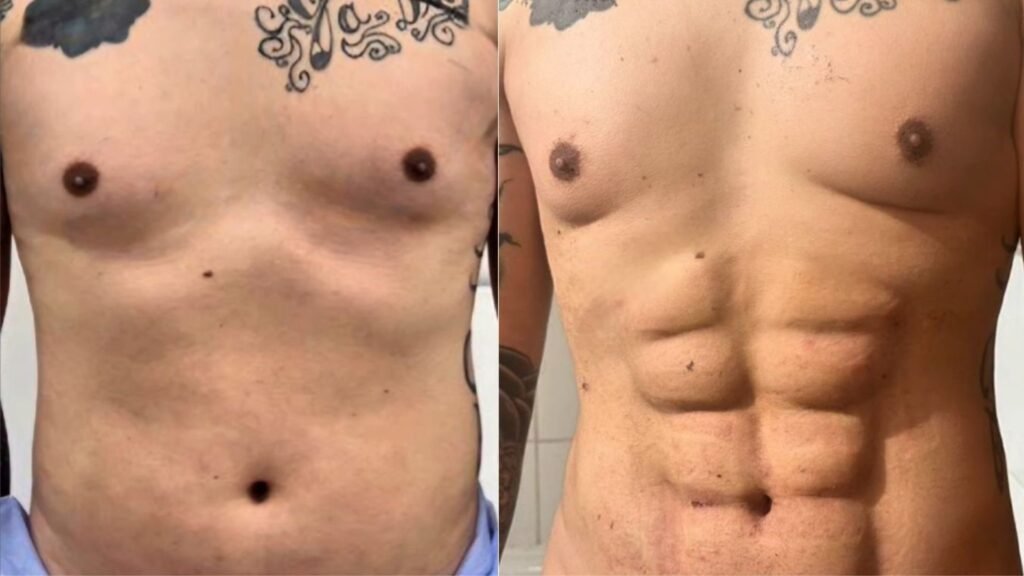 Dr. Elmer Terrazas: Pionero en Cirugía Plástica y Lipo Marcación Abdominal en Chile