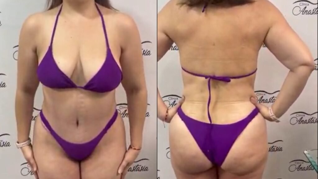 Mommy Makeover en Chile: Cómo el Dr. Elmer Terrazas Transforma Vidas