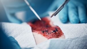 La muerte del tejido: qué ocurre cuando una herida se necrosa y cómo se debe actuar